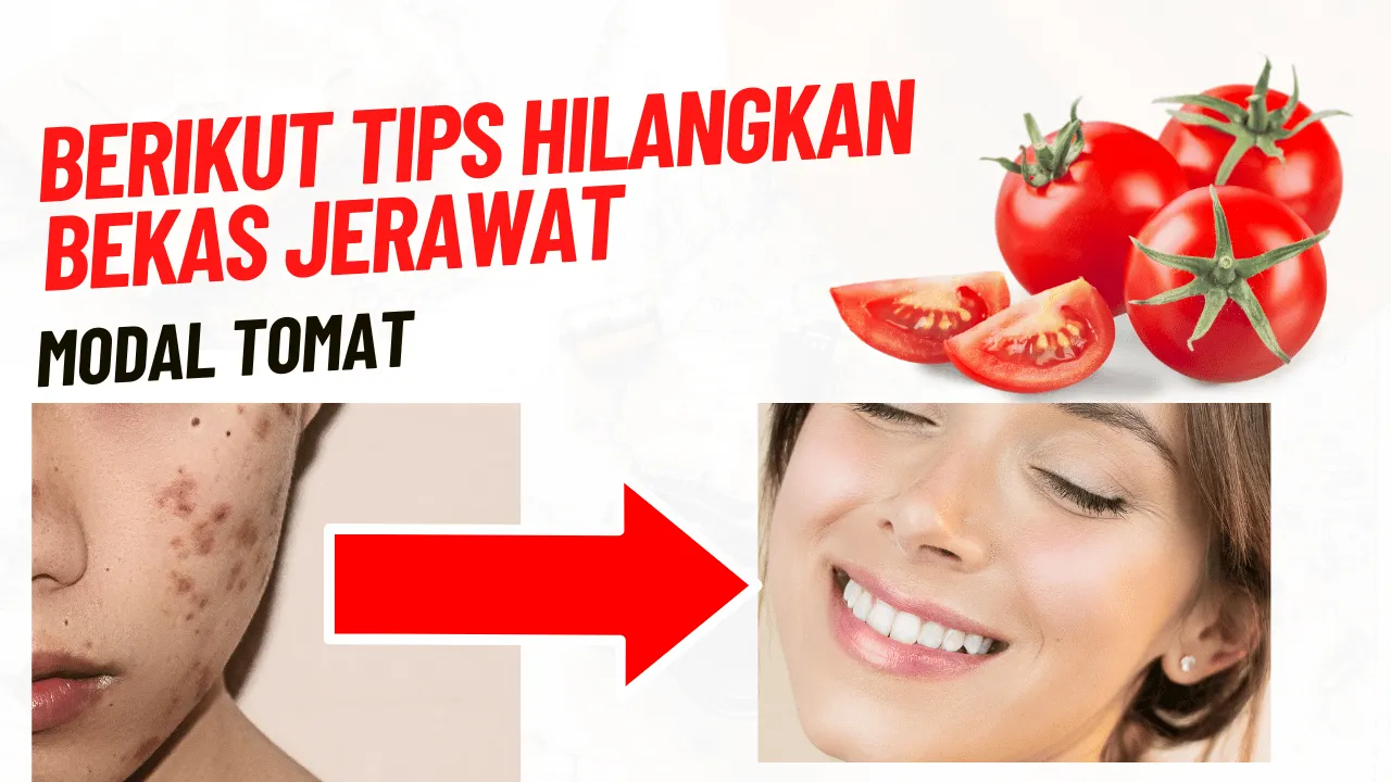 Cara Hilangkan Bekas Jerawat